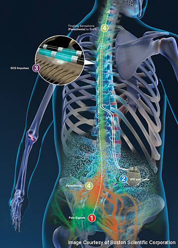 Spinal Cord Stimulation